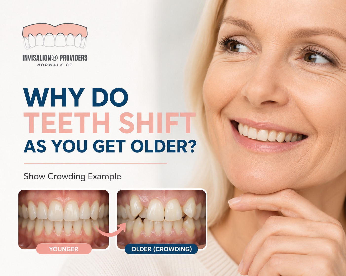 Comparison showing dental crowding that develops with age and how teeth can shift over time in adults.